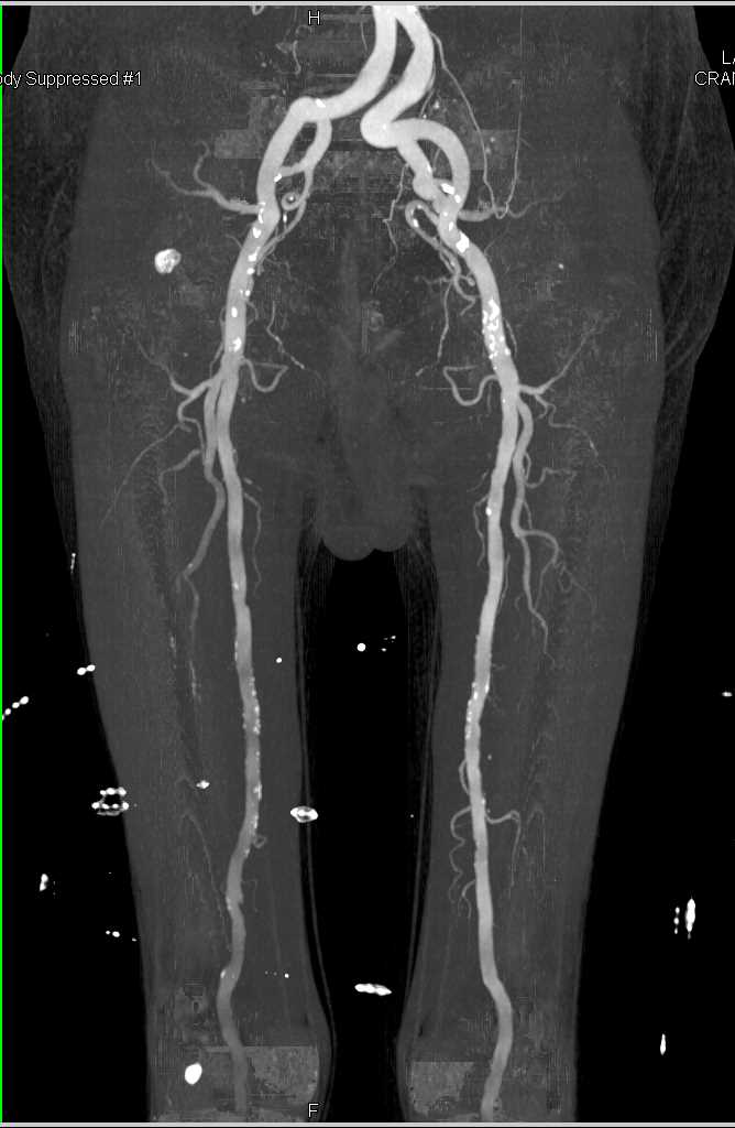 Dual Energy CT Angiogram with Peripheral Vascular Disease - CTisus CT Scan