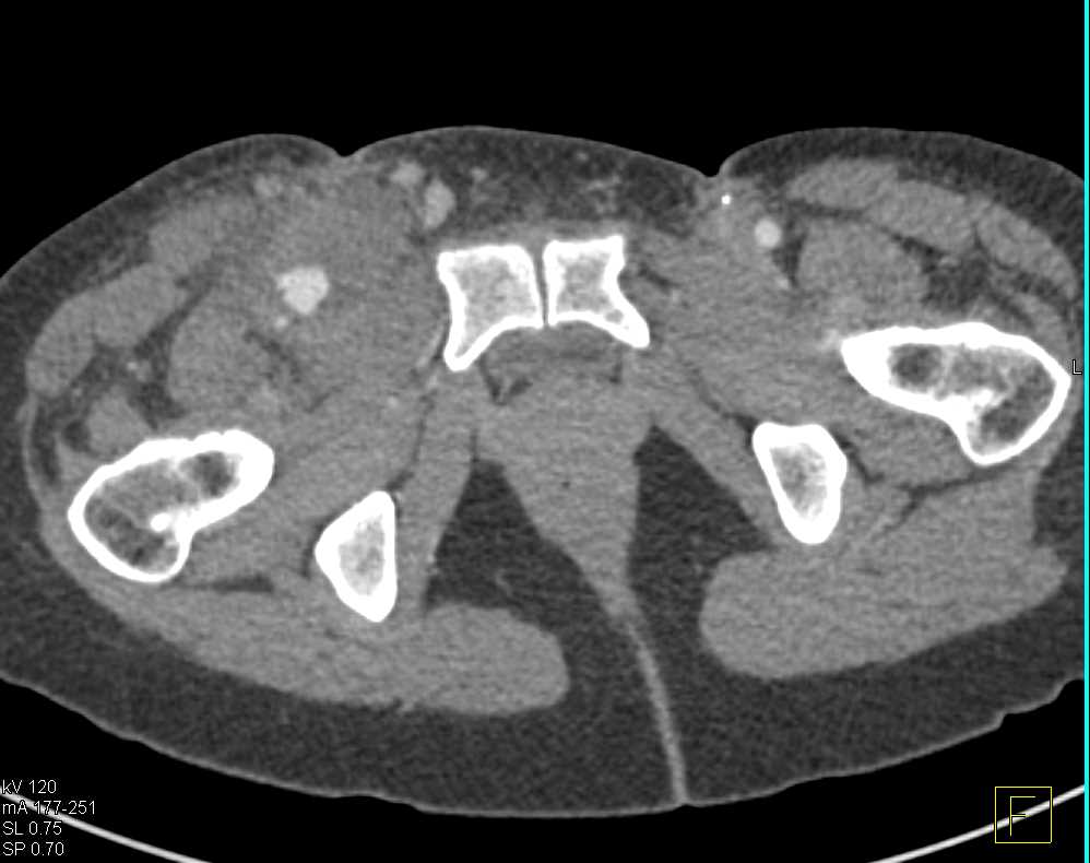 Pseudoaneurysms Right Superficial Femoral Artery - CTisus CT Scan