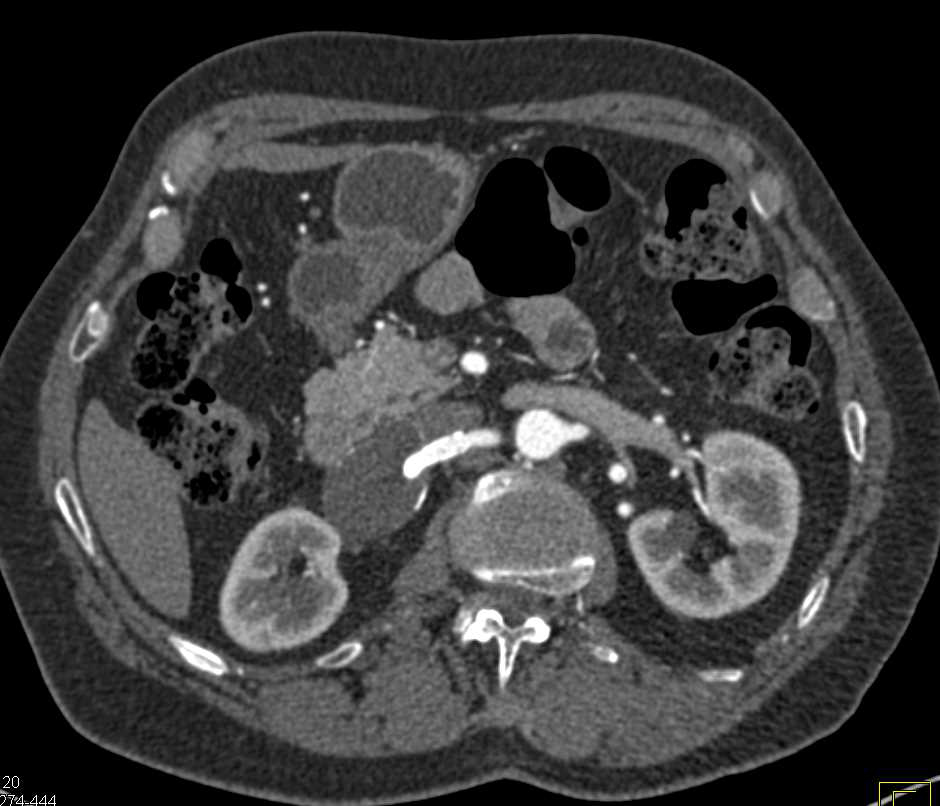 Stent in Right Renal Artery for Treatment of Renal Artery Aneurysm - CTisus CT Scan