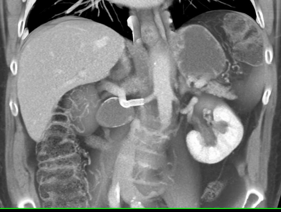 Stent in Right Renal Artery for Treatment of Renal Artery Aneurysm - CTisus CT Scan