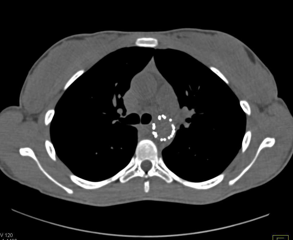 Endovascular Stent Repair of Thoracic Aorta - CTisus CT Scan