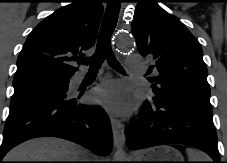 Endovascular Stent Repair of Thoracic Aorta - CTisus CT Scan