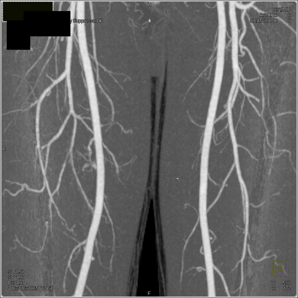 CTA s/p GSW Without Vascular Injury - CTisus CT Scan