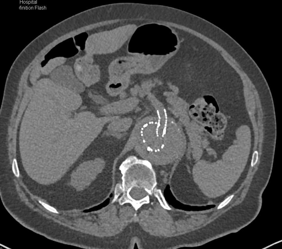 Complex Endovascular Stent Repair with Small Endoleak - CTisus CT Scan