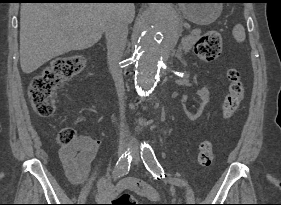 Complex Endovascular Stent Repair with Small Endoleak - CTisus CT Scan