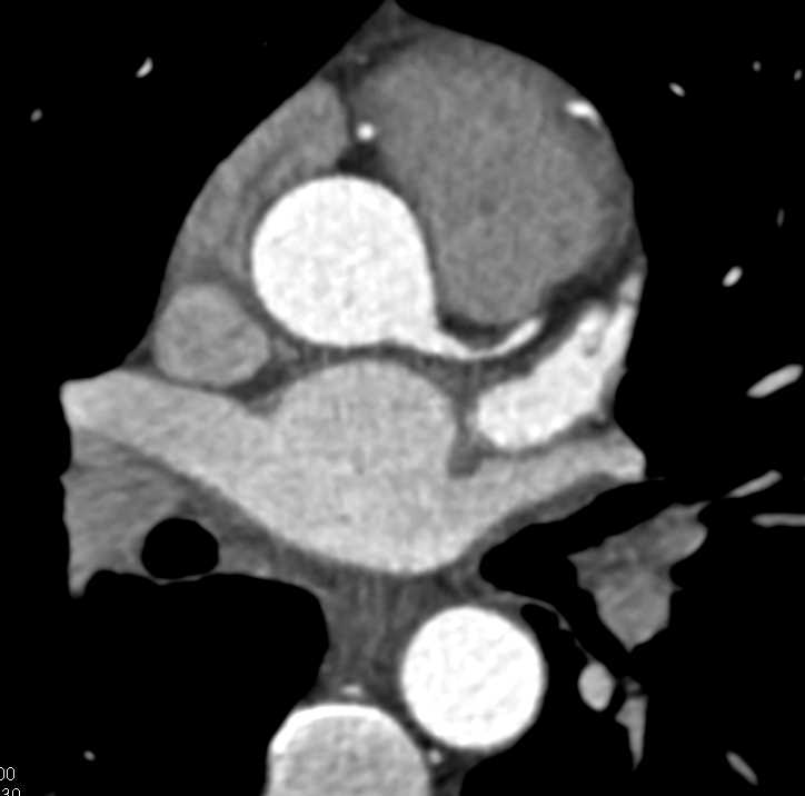 CCTA: Left Anterior Descending Coronary Artery (LAD) Stenosis of Over 50% With Noncalcified Plaque - CTisus CT Scan