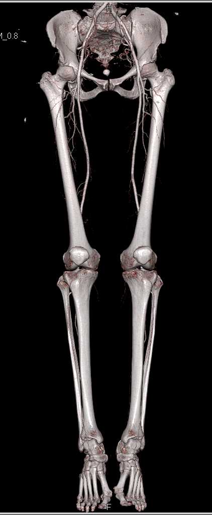 Normal DE CT Runoff - CTisus CT Scan