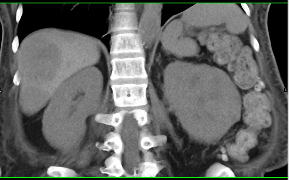 Infiltrating Renal Cell carcinoma Invades the Left Renal Vein and the Inferior Vena Cava (IVC) with Liver Metastases - CTisus CT Scan