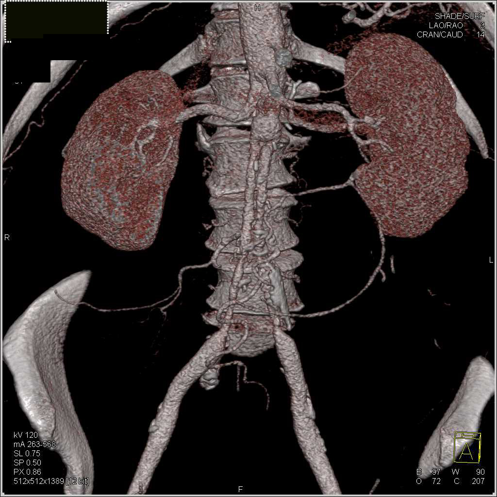 Ehlers-Danlos Syndrome with Failing Iliac Grafts - CTisus CT Scan