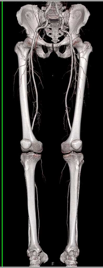 CTA Runoff with Artifact in Trifurcation Vessels - CTisus CT Scan