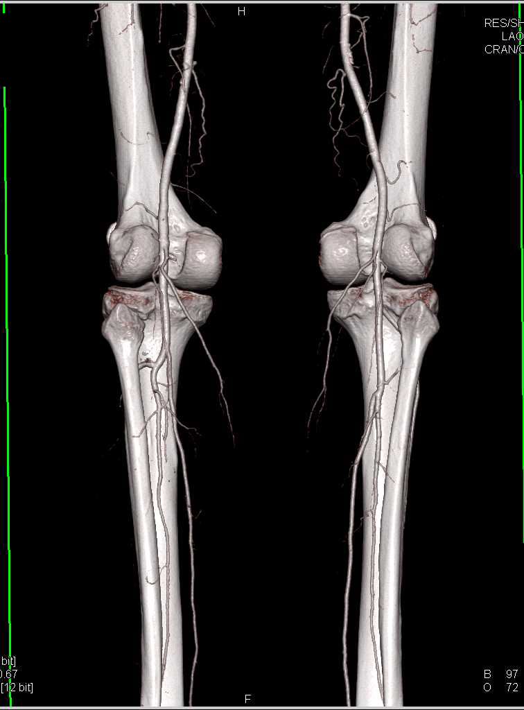 CTA Runoff with Normal Vascular Map - CTisus CT Scan