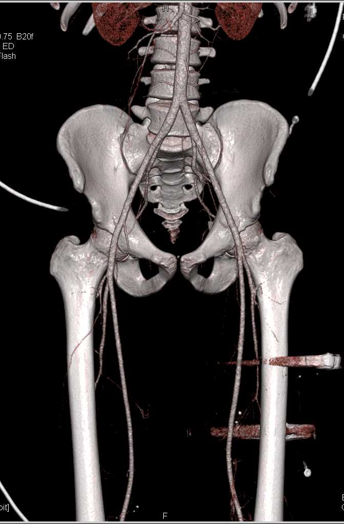 Multiple GSW Lower Extremities Without Contrast Extravasation - CTisus CT Scan