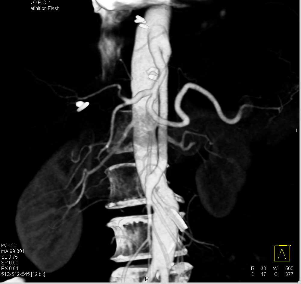 Reconstructed Compound Trunk for Superior Mesenteric Artery (SMA) and Celiac Arteries - CTisus CT Scan