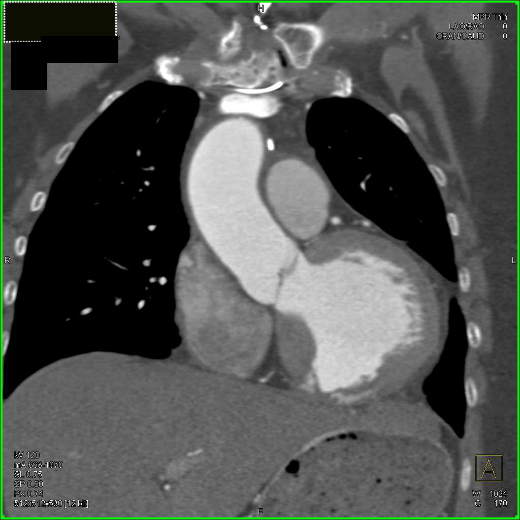 Left Ventricular Aneurysm - CTisus CT Scan