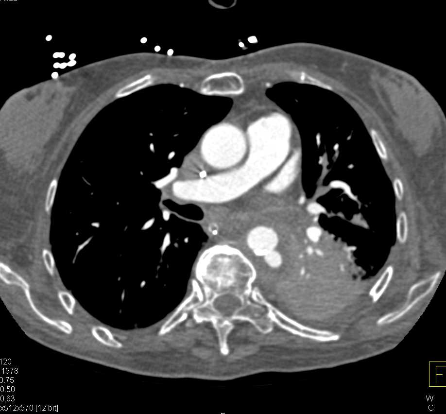 Ulceration Descending Aorta with Intramural Hematoma - CTisus CT Scan