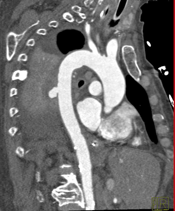 Ulceration Descending Aorta with Intramural Hematoma and Left Lower Lung Collapse - CTisus CT Scan