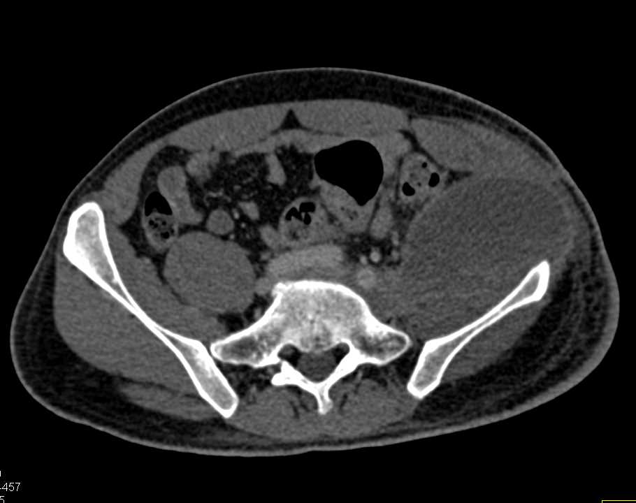 Hematoma Left Pelvis Following Graft Placement - CTisus CT Scan