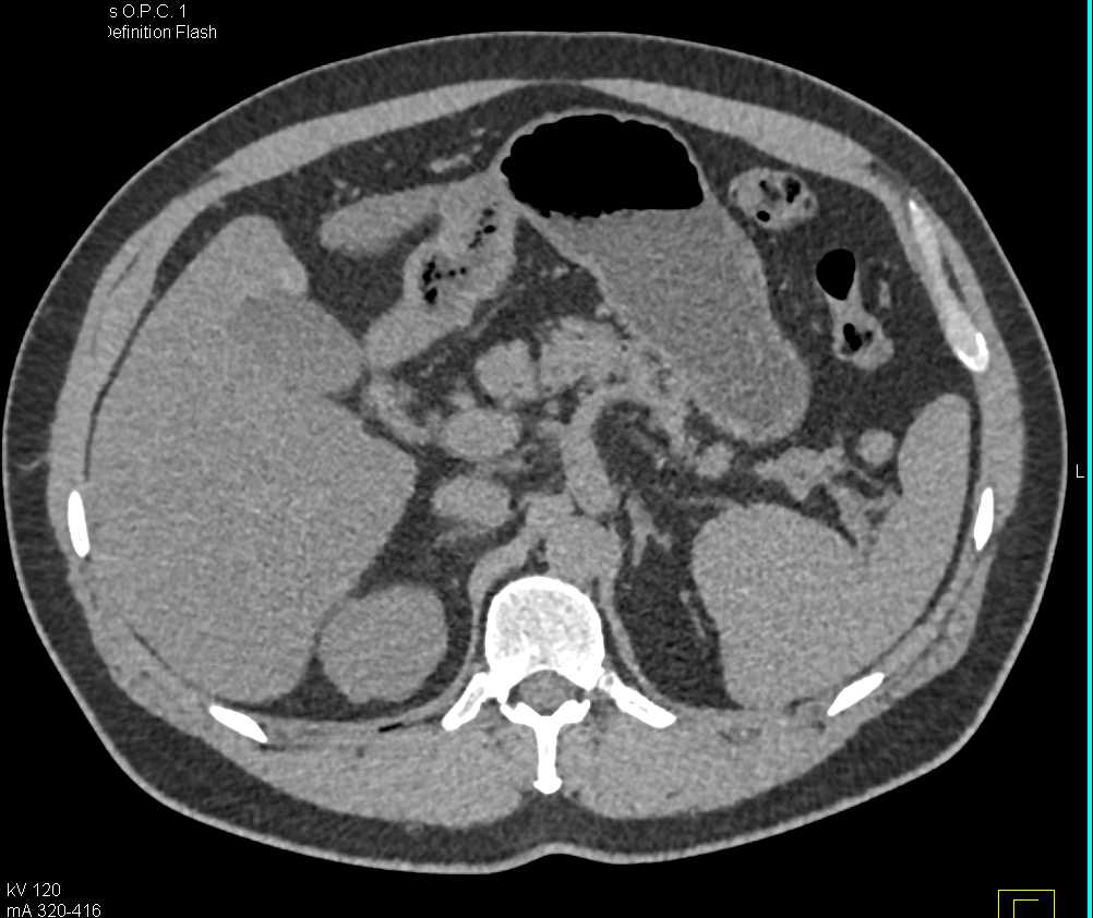 Superior Mesenteric Artery (SMA) Dissection with Vasculitis - CTisus CT Scan