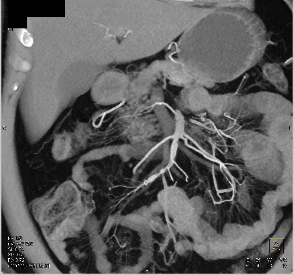 Superior Mesenteric Artery (SMA) Dissection with Vasculitis - CTisus CT Scan