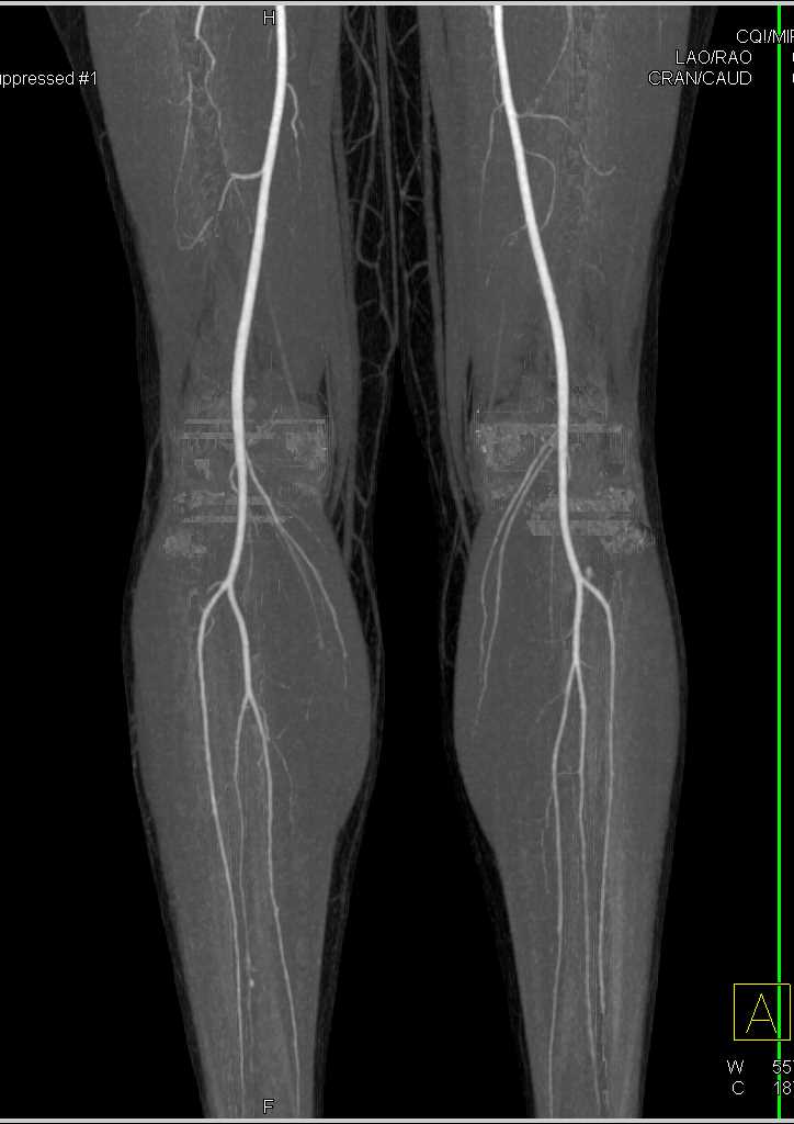 CTA DE Runoff with Good Visualization of the Trifurcation Vessels - CTisus CT Scan