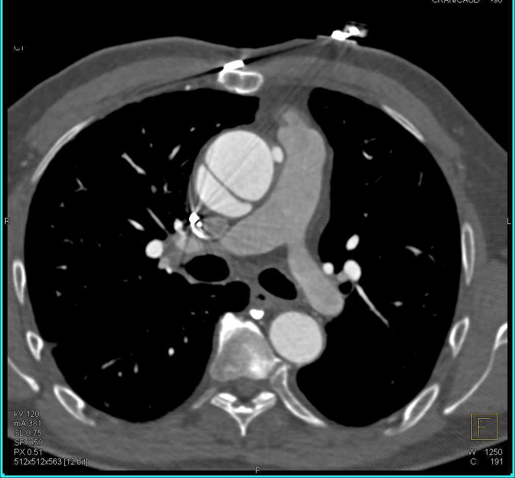 Type A Dissection in a Patient with Prior Aortic Valve Replacement (AVR) - CTisus CT Scan