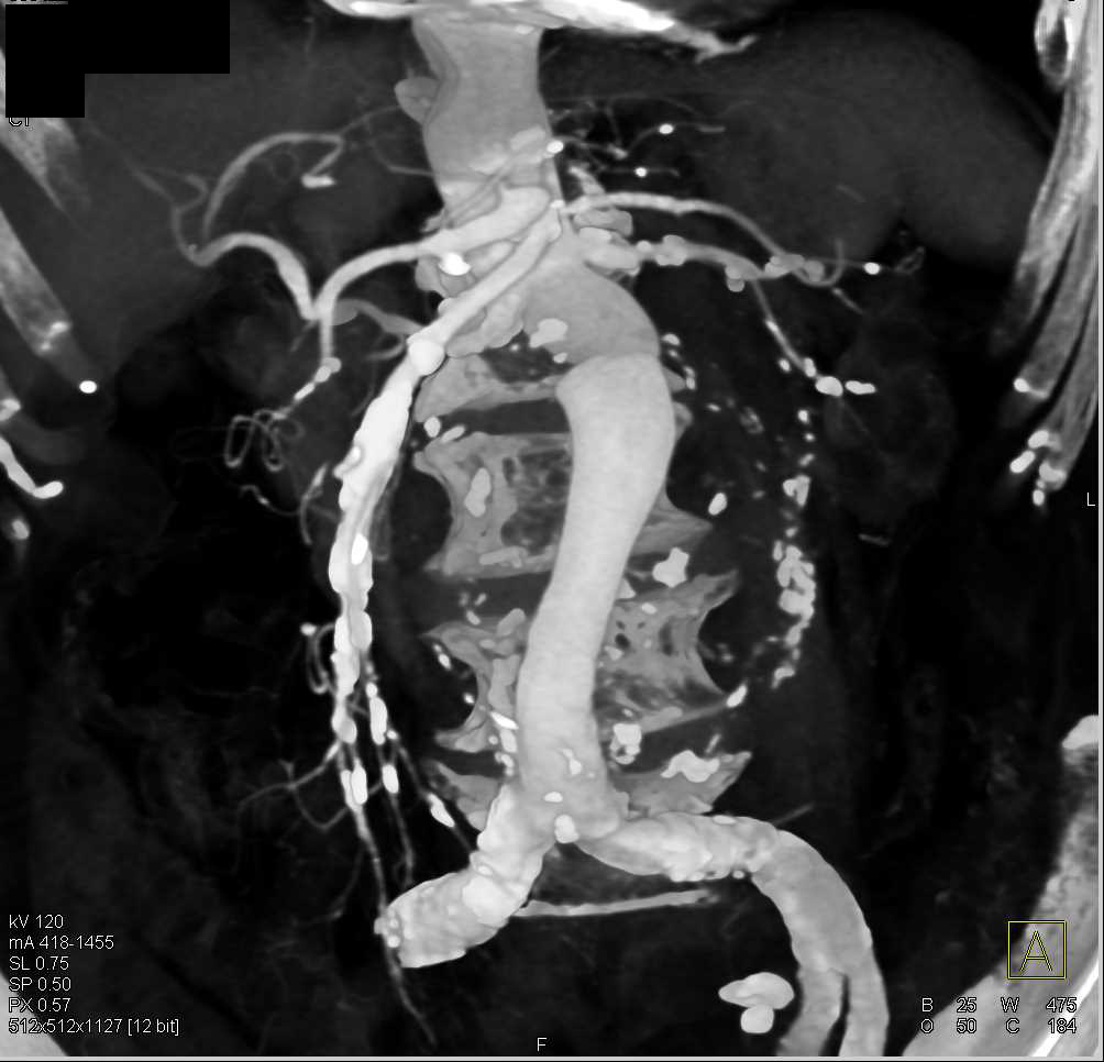 Large Abdominal Aortic Aneurysm with Repair - CTisus CT Scan