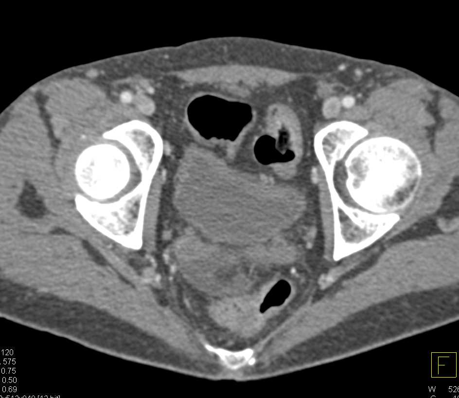 Left Femoral Vein Deep Vein Thrombosis (DVT) in Patient with Pancreatic Cancer and Stents in Place - CTisus CT Scan