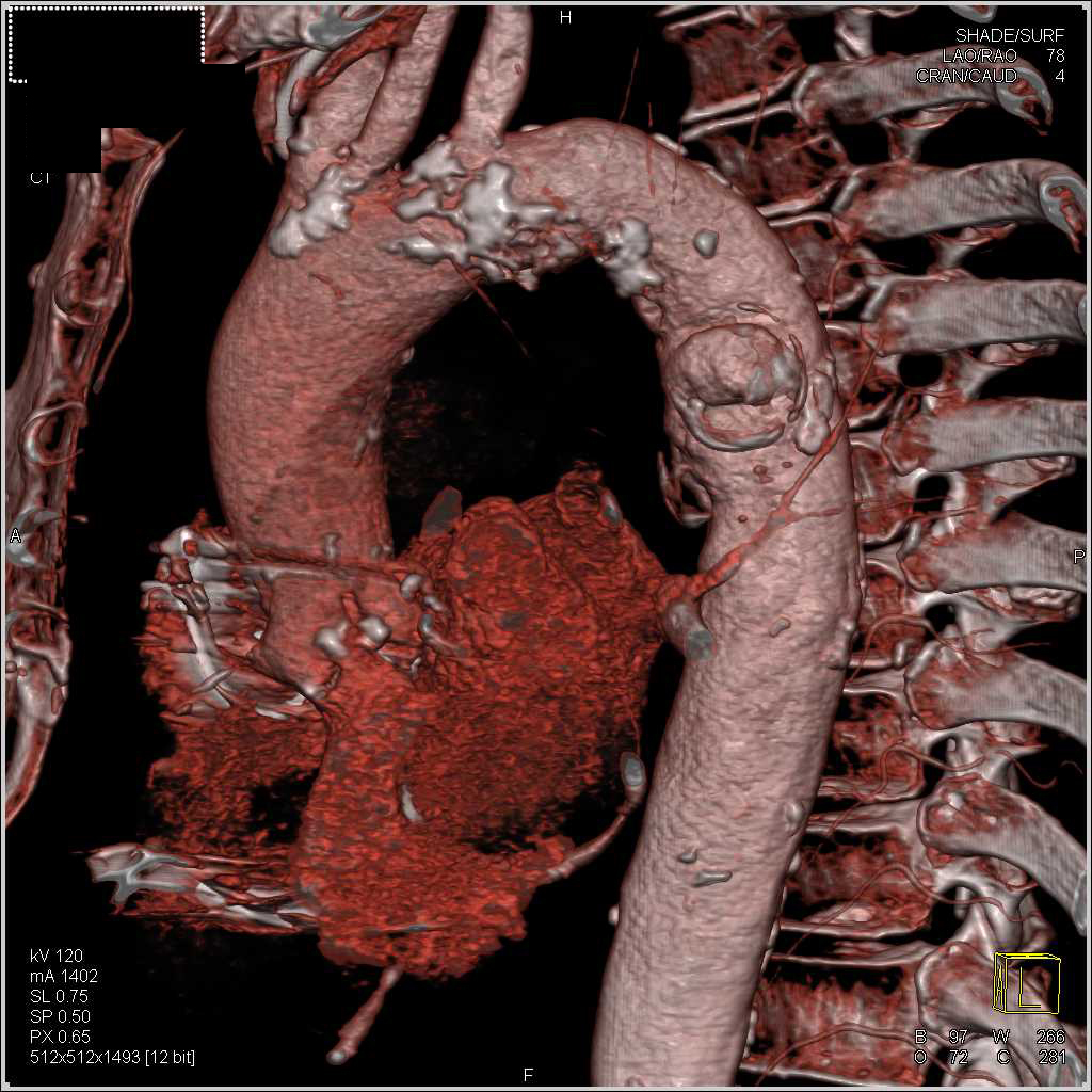 Focal Ulceration Descending Thoracic Aorta - CTisus CT Scan