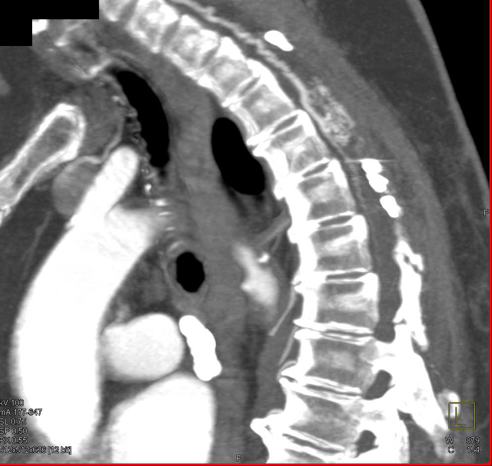 Atheromatous Plaque in Arch - CTisus CT Scan