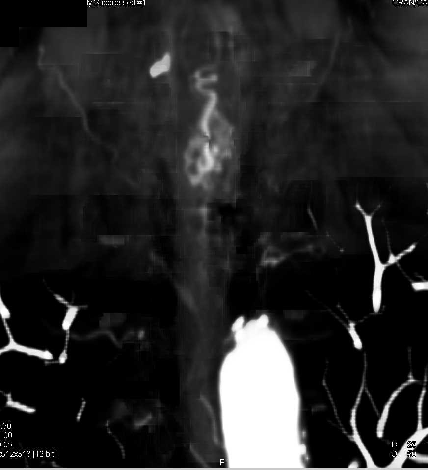 Arteriovenous Malformation (AVM) Spinal Cord - CTisus CT Scan