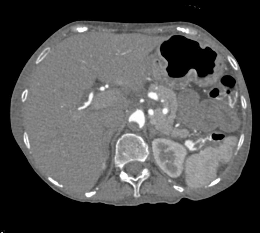 Unusual Clot in Abdominal Aorta and a Site for Emboli - CTisus CT Scan