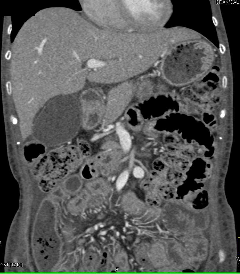 Unusual Clot in Abdominal Aorta and a Site for Emboli - CTisus CT Scan