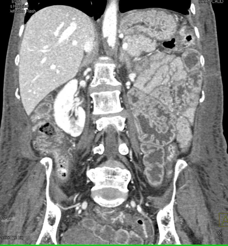 Thrombus in the Abdominal Aorta with Dilated Small Bowel - CTisus CT Scan