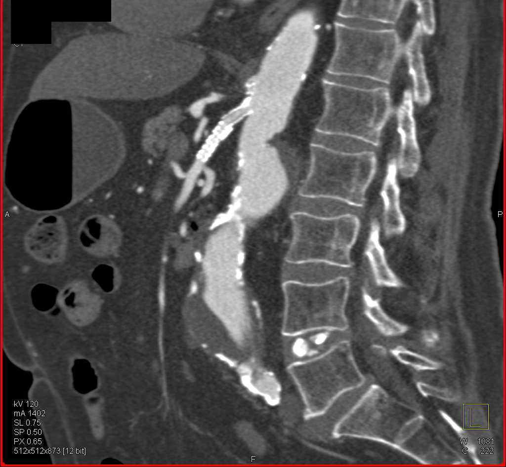 Aortic Aneurysm with Stent in the SMA - CTisus CT Scan