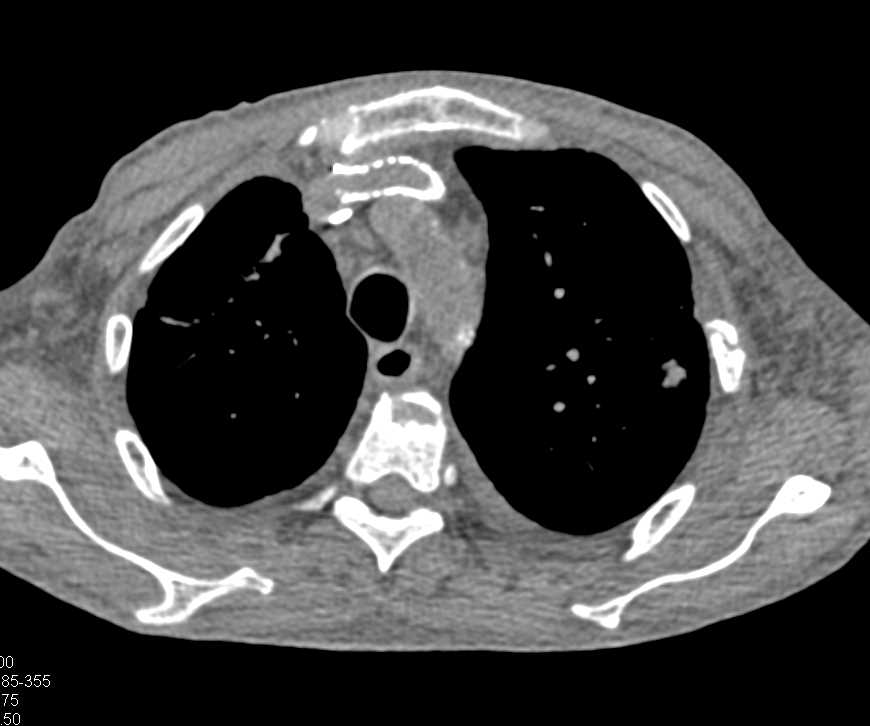 Incredible Example of Superior Vena Cava (SVC) Clot due to Indwelling Catheter - CTisus CT Scan