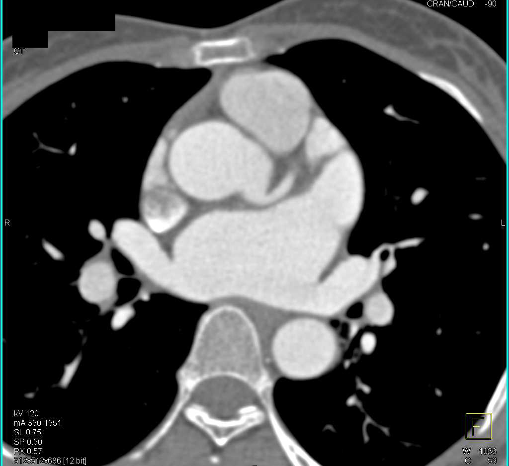 Dilated Aortic Root with Pseudo-Dissection due to Motion - CTisus CT Scan