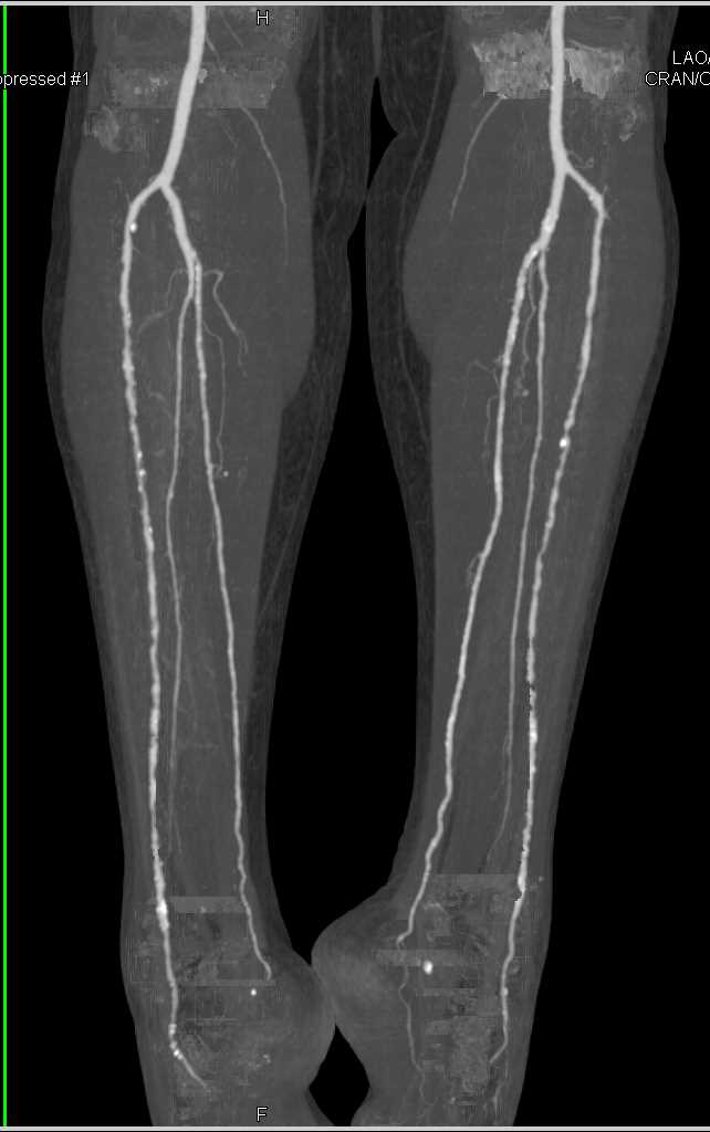 CTA DE Runoff with Good Visualization of the Trifurcation Vessels - CTisus CT Scan