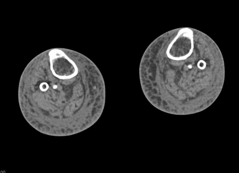 CTA Runoff with DE and Perioheral Vascular Disease - CTisus CT Scan