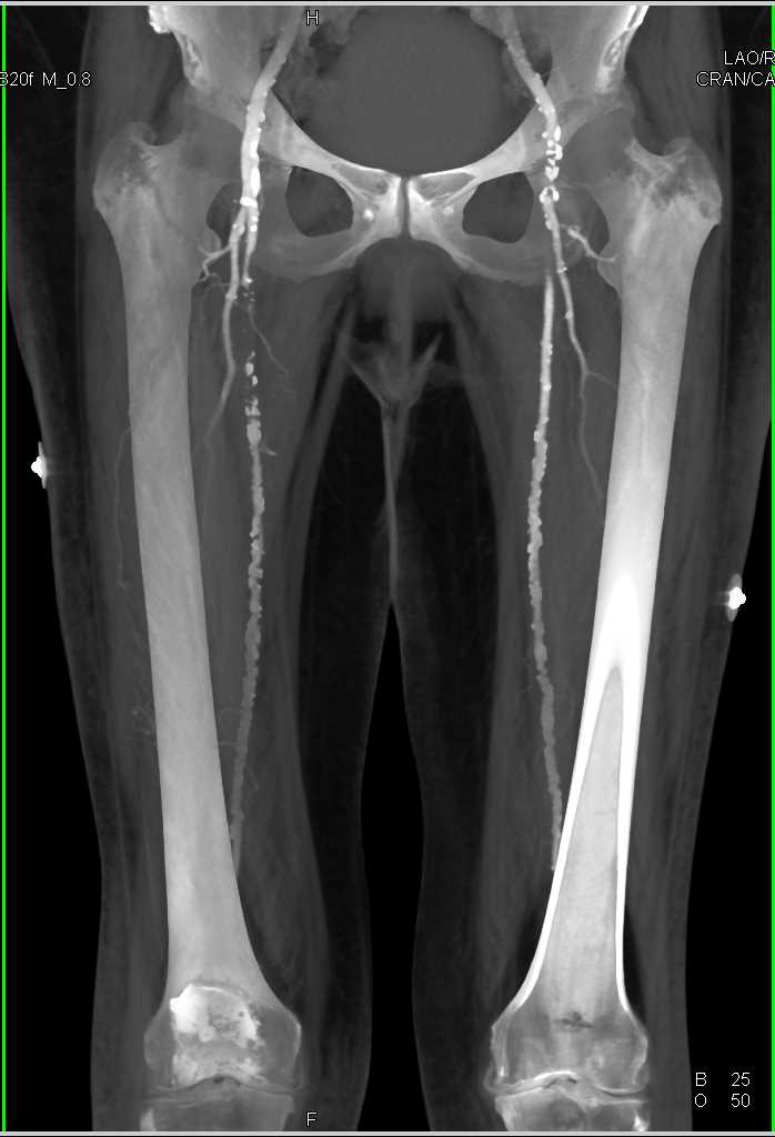 CTA Runoff with DE and Perioheral Vascular Disease - CTisus CT Scan