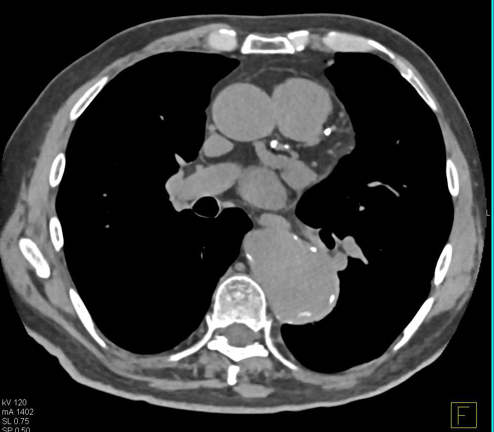 Patent Superior Mesenteric Artery (SMA) and Celiac Stents - CTisus CT Scan