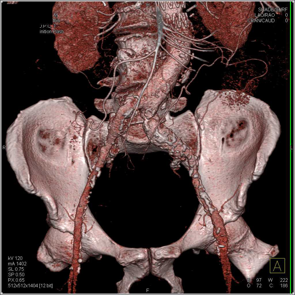 Complex Vascular Repair with Stents in the Renal Arteries as well as the Superior Mesenteric Artery (SMA) and Celiac Artery - CTisus CT Scan