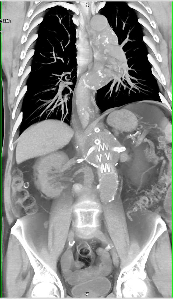 Endovascular Stent Repair - CTisus CT Scan