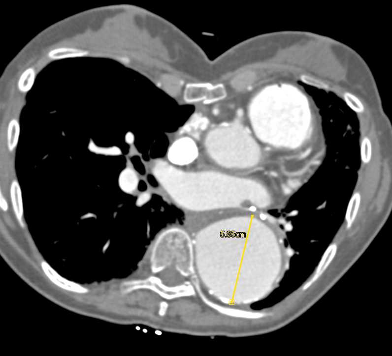 Thoracic and Abdominal Aortic Aneurysm - CTisus CT Scan