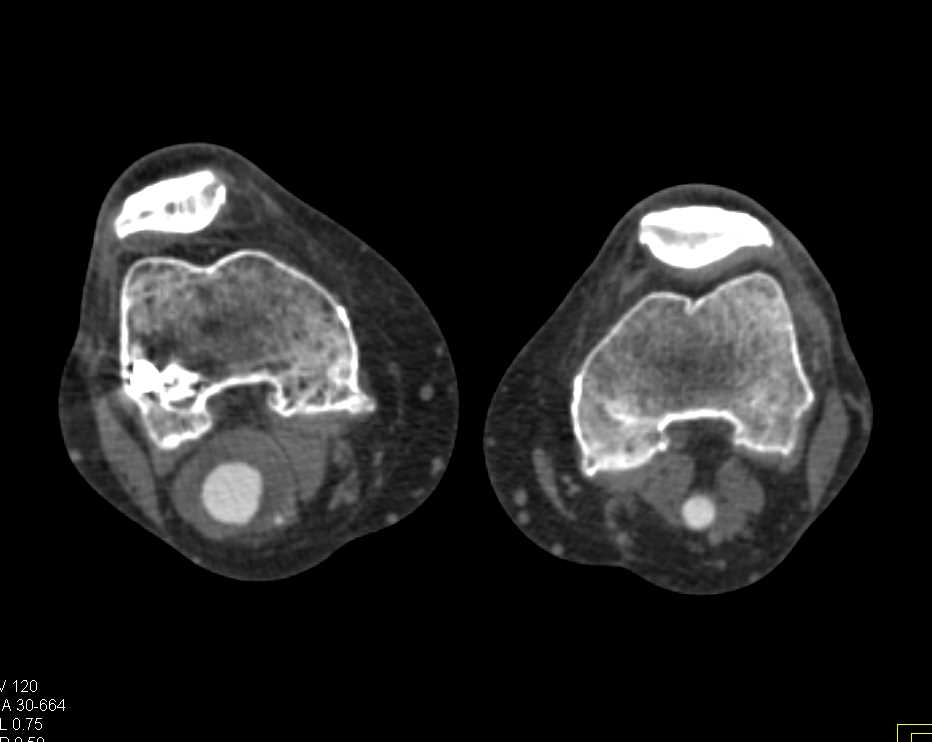 Right Popliteal Artery Aneurysm - CTisus CT Scan