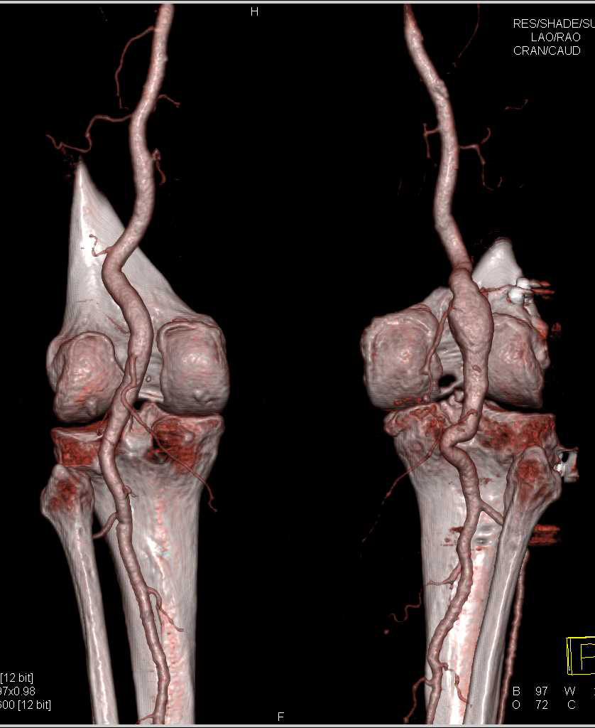 Right Popliteal Artery Aneurysm - Vascular Case Studies - CTisus CT