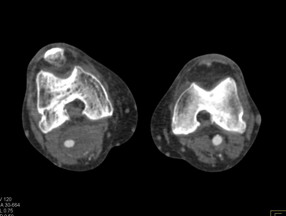 Right Popliteal Artery Aneurysm - CTisus CT Scan