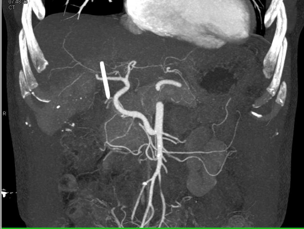 Accessory Right Hepatic Artery off the Superior Mesenteric Artery (SMA) in Pancreatic Cancer - CTisus CT Scan