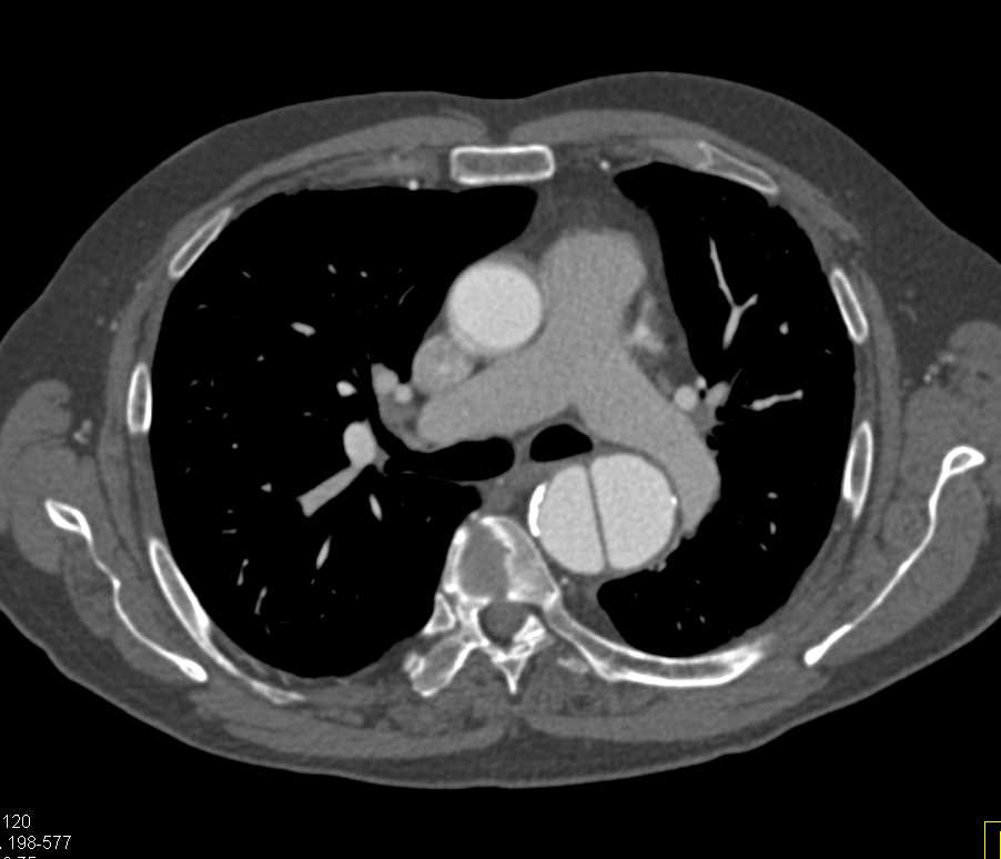 Type B Dissection and Right Common Iliac Artery Aneurysm - CTisus CT Scan