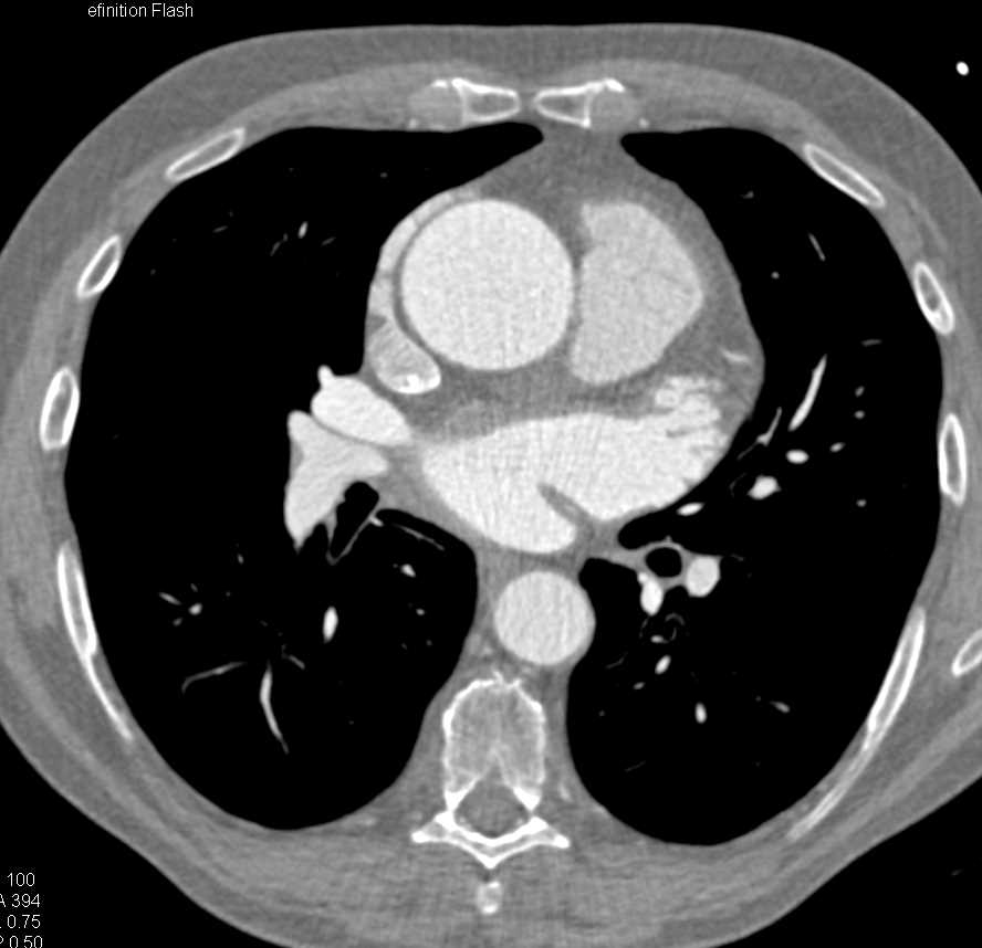 Marfan Syndrome with Dilated Aortic Root - CTisus CT Scan