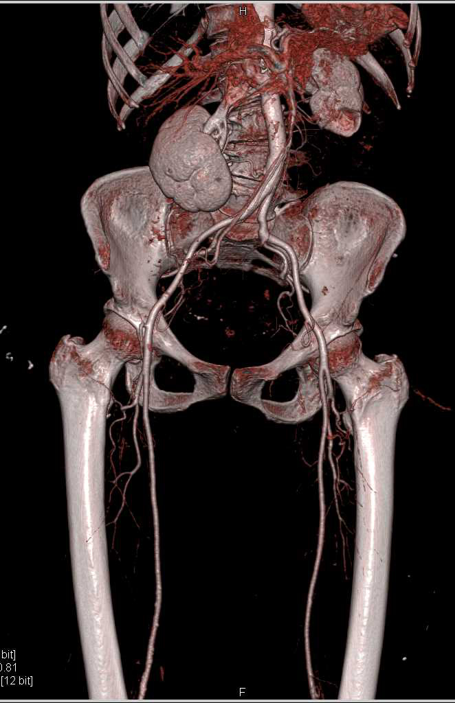 CTA rRunoff with Peripheral Vascular Disease - CTisus CT Scan